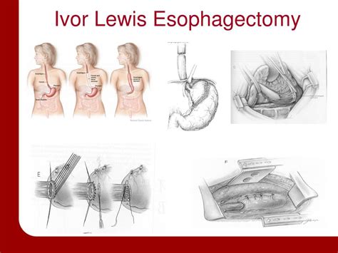 salvage surgery esophageal cancer