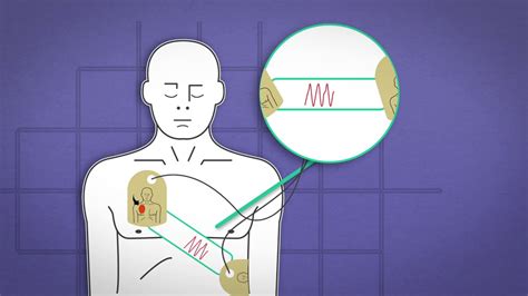 sam stand for in cpr