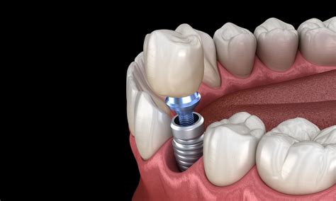 same day single tooth implant