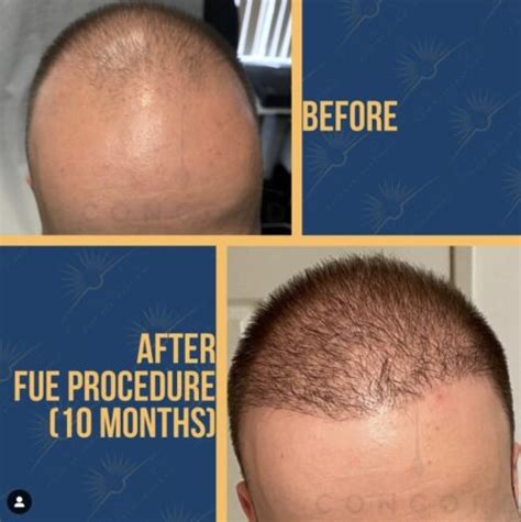 san diego hair transplant cost