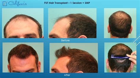 san francisco hair transplant