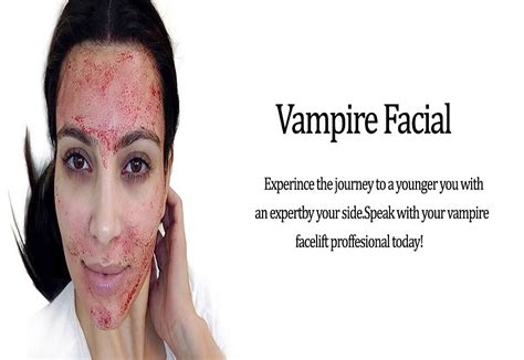 san francisco vampire facial procedure