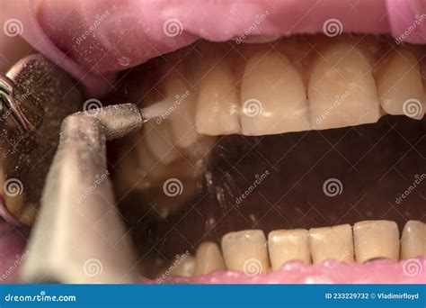 Sandblasting Teeth Whitening