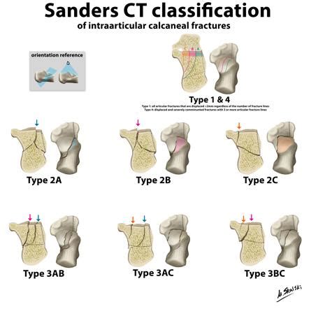 Sanders Classification Radiopaedia