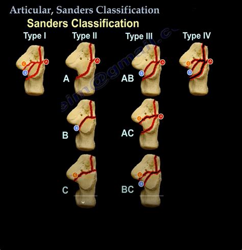 Sanders Classification System