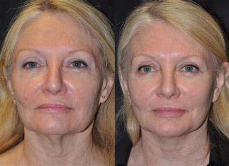 santa barbara facelift