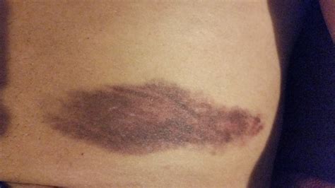 sarcoma bruise