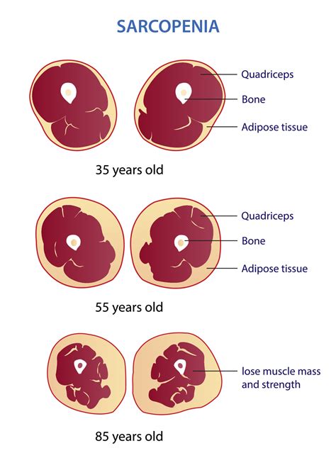 sarcopenia