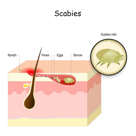 Scabies Causes, Transmission, Symptoms, Diagnosis, Treatment And