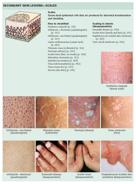 Scale Definition Dermatology