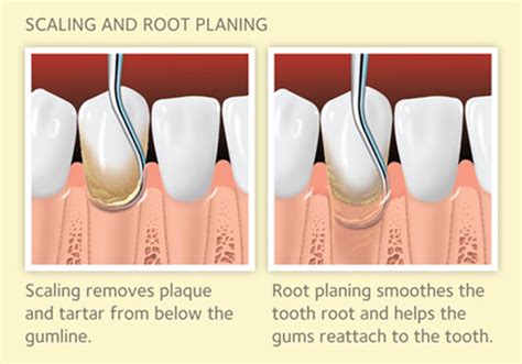 Scaling And Root Planing Ada Code