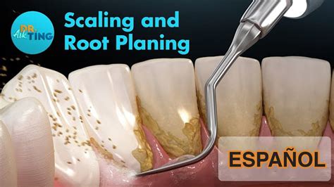 Scaling And Root Planing Explanation In Spanish