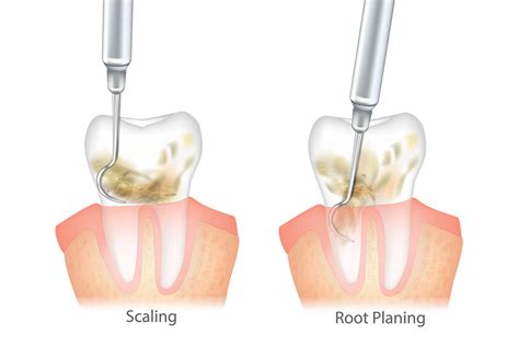 Scaling And Root Planing Refusal Form
