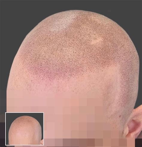 Scalp Micropigmentation Cincinnati