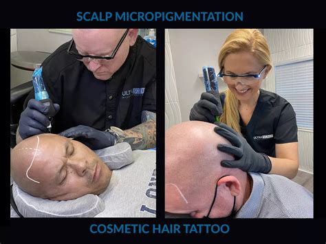 Scalp Micropigmentation Groupon