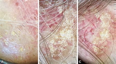 scalp problems with lupus