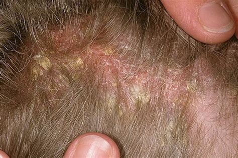 scalp seborrheic dermatitis icd 10