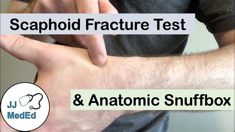 Diagnosing Scaphoid Fractures: The Scaphoid Fracture Test Explained