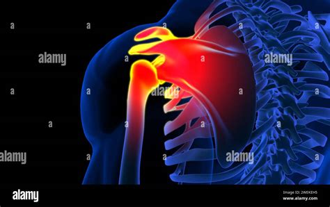 Scapula Bone Pain