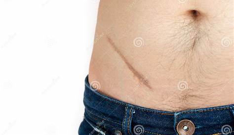 Big Scar After Appendicitis Surgery Stock Image Image of