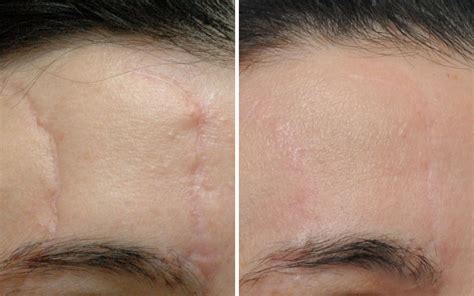 SCAR BEFORE AND AFTER 1 TREATMENT (1) Revive Laser and Skin Clinic