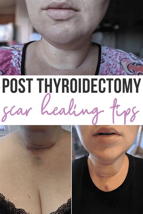 Scar Care After Thyroid Surgery