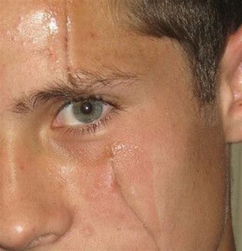 Understanding the Causes and Treatments of a Scar on Eye: What You Need to Know