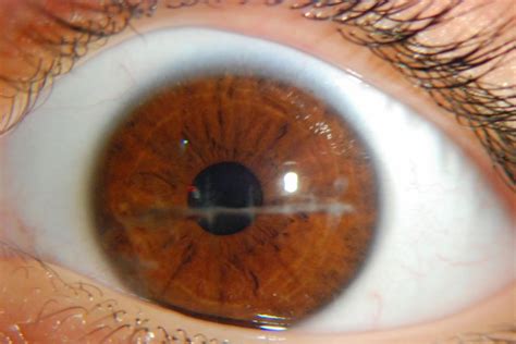 Understanding the Rare Condition of a Scar on Eyeball