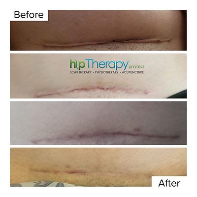 Scar Therapy C Section