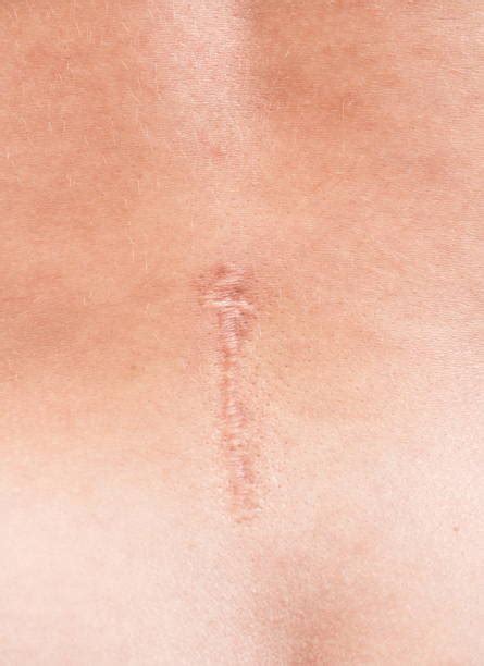 scar tissue in back after surgery