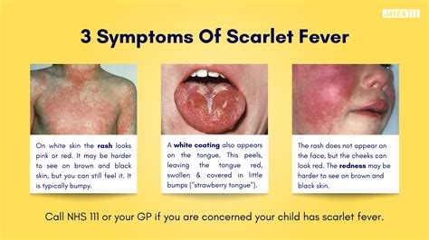 scarlet fever vs viral rash