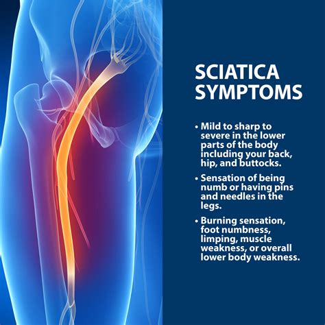 sciatica