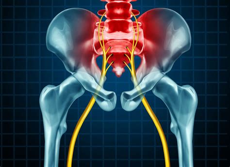 Chiropractic Treatment Options for Sciatica