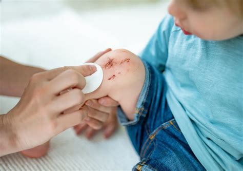 Scraped Knee Weeping