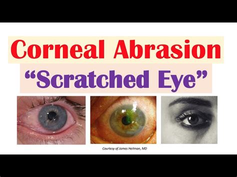 Understanding and Treating a Scratch on Eye Safely