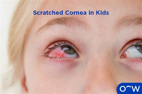 Beware: The Dangers of Scratching Your Cornea Explained