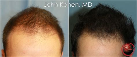 Best Hair Transplant Seattle Revive Hair Restoration Best Hair