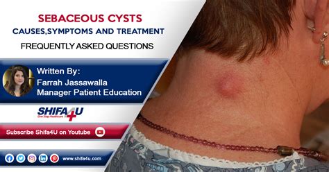 sebaceous cyst causes and symptoms