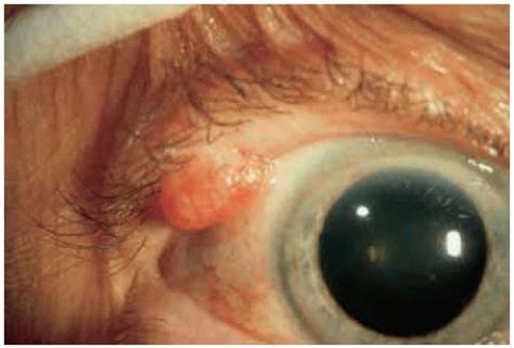 sebaceous cyst eyelid papillomas