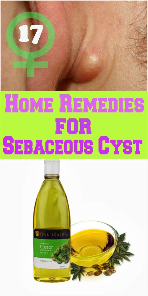 sebaceous cyst home remedy