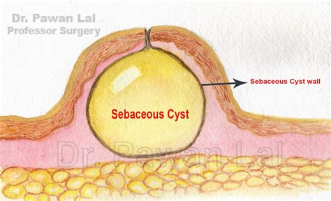 sebaceous cyst on scrotum sack