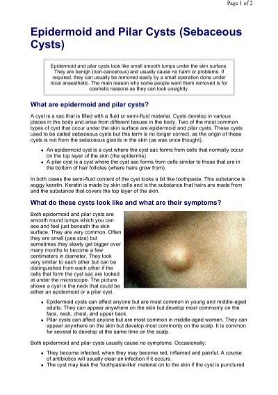sebaceous cyst patient information pdf