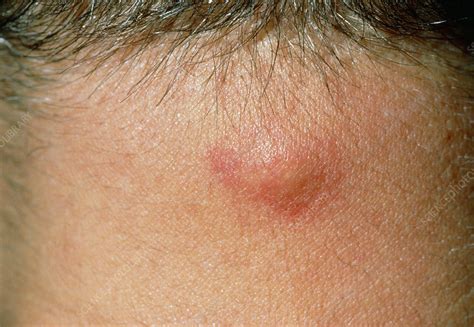 sebaceous cyst pictures on neck