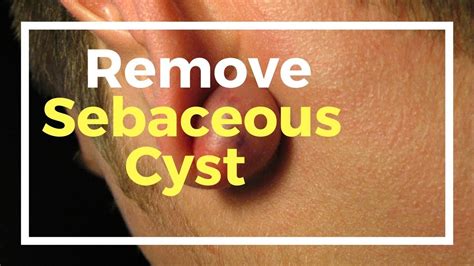 sebaceous cyst removal at home