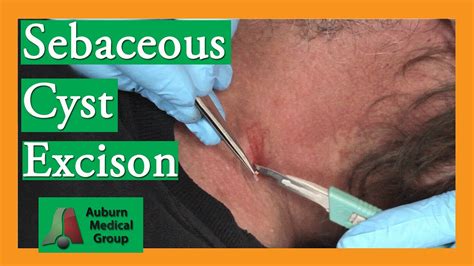 sebaceous cyst removal video