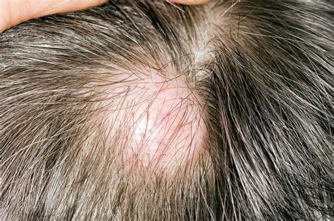 sebaceous cyst scalp hair loss