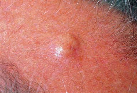 sebaceous cyst scalp image