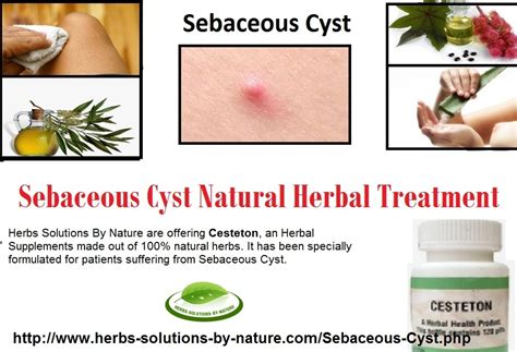 sebaceous cyst treatment antibiotics