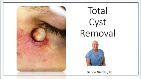 sebaceous cyst treatment without surgery