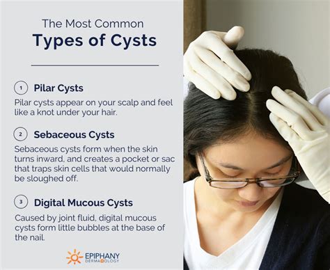 Sebaceous Cyst Types